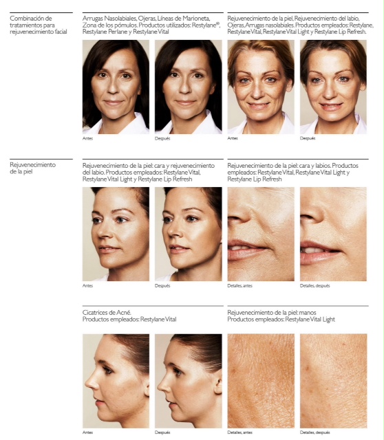 Rejuvenecimiento Facial en las islas Canarias